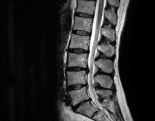 MRT Bildausschnitt der Lendenwirbelsäule LWS